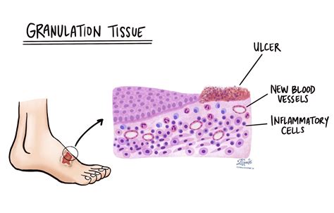 Granulation Tissue