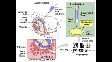 morzespokoju: chorionic villus sampling