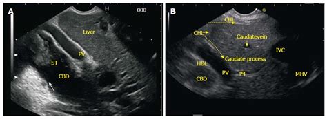 Imaging of common bile duct by linear endoscopic ultrasound