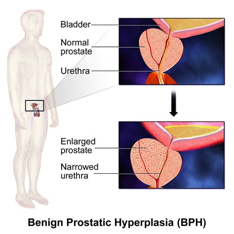 Benign Prostatic Hyperplasia Causes, Sign & Symptoms