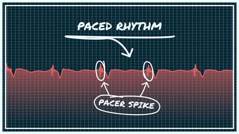 What Paced Rhythm Looks Like on Your Watch ECG | Qaly