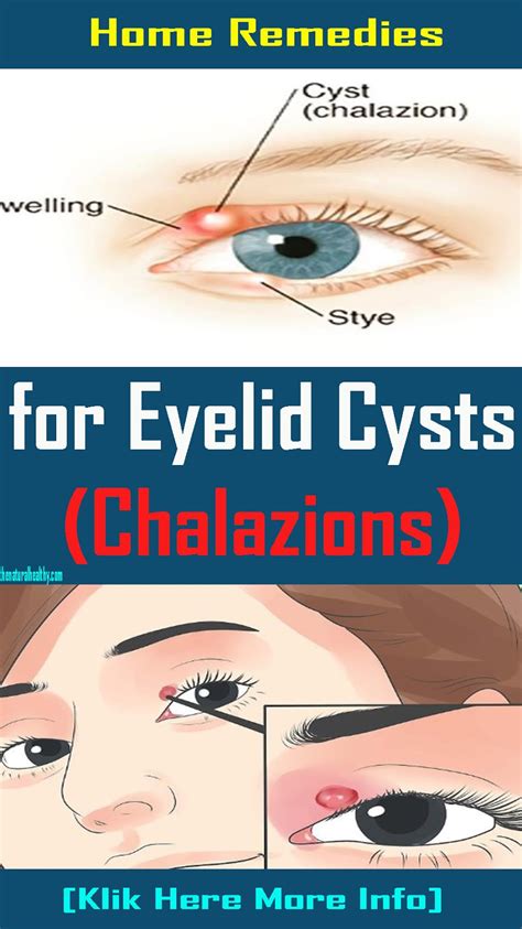 Home Remedies for Eyelid Cysts (Chalazion) - The News Pins