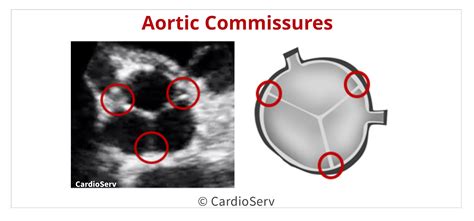 Back to the Basics: Aortic Valve Anatomy Cardioserv