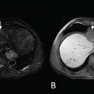 (a) Pretreatment scans (MRI). Axial T2 WI (A) and postcontrast (Eovist)... | Download Scientific ...