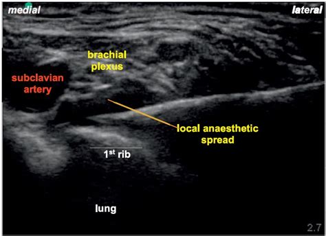 Ultrasound-Guided Supraclavicular Brachial Plexus Block : WFSA - Resources