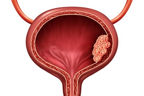 Intravesical Gene Therapy for Non-Muscle Invasive Bladder Cancer - ACE Oncology