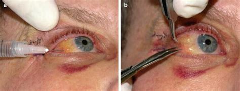 Step-by-Step Treatment of Post-blepharoplasty Chemosis | SpringerLink