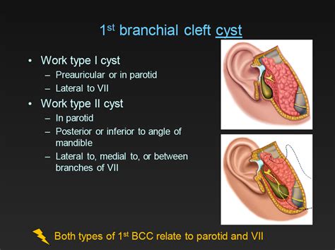 First Branchial Cleft Cyst