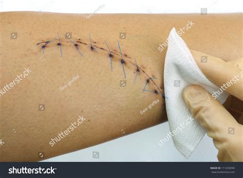 Closeup Cleaning Stitched Wound On Male Stock Photo 111293090 ...