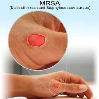 MRSA Infection: Symptoms, Causes, Treatment, Contagious, Pictures ...