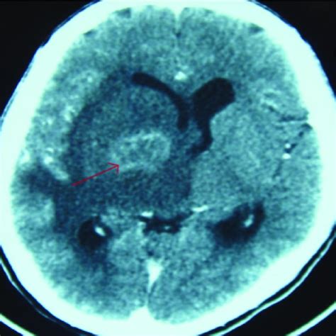 Computerized brain scan showing a ring enhancing lesion in the right... | Download Scientific ...