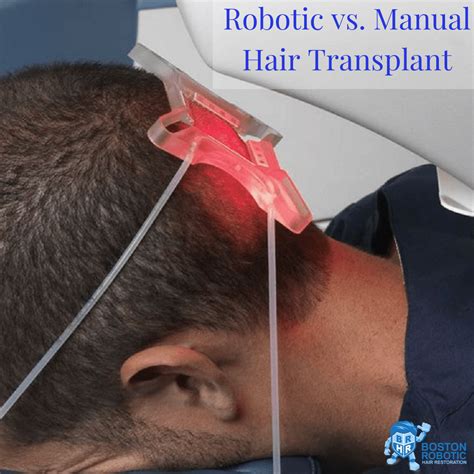 Robotic vs. Manual Hair Transplant - RoboHair Boston