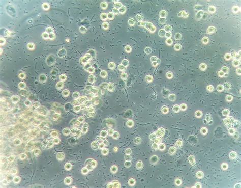 Urine Sediment of the Month: Bacterial Variant Forms - Renal Fellow Network