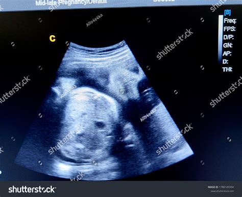 Fetal Face 36 Weeks By Ultrasound Stock Photo 1788145994 | Shutterstock