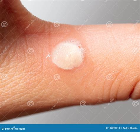 Hydrogen Peroxide on Corn on the Skin Stock Image - Image of horizontal, stand: 139692913