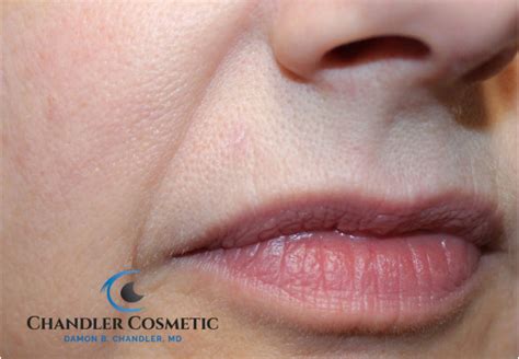 Mole On Lip Removal Cost | Sitelip.org