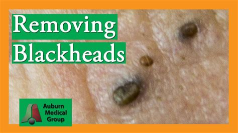 Massive infected cyst #blackheads #shorts #skincare Dr Khaled Sadek LIPOMACYST clinic