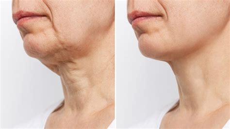 Neck Rejuvenation – Valley Laser and Skin