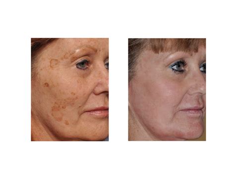 Laser Treatment For Brown Spots On Face