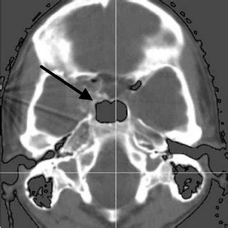 CT scan of a chondrosarcoma of the base of the skull ( 0 / ) at the ...