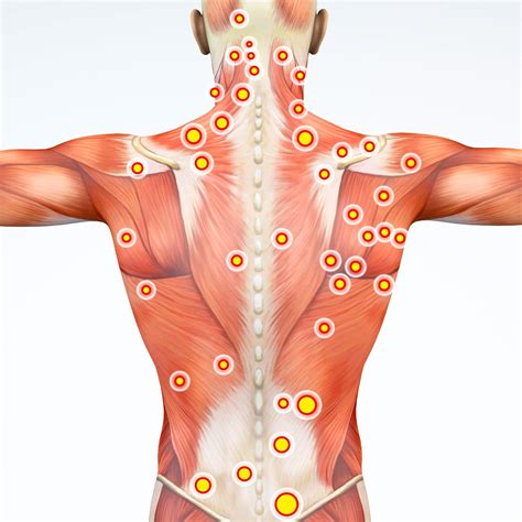 Trigger Point Dry Needling | Strive PT