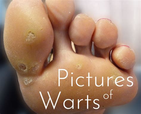 Pictures of Warts: Causes, Types and Home Treatments | HubPages