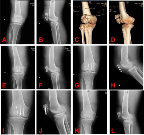 Frontiers | Clinical application of Kirschner wires combined with 5-Ethibond fixation for ...