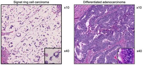 Investigation of clinicopathological characters and gene expression features in colorectal ...