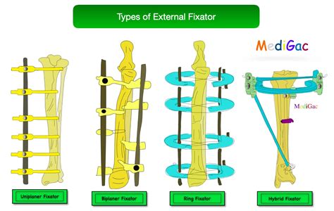 External fixation – Indications, Types, Working principle, Complications – MediGac