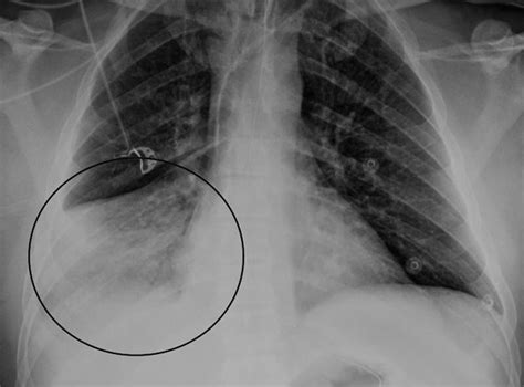 Figure 1 - Encephalitis-Associated Human Metapneumovirus Pneumonia in ...