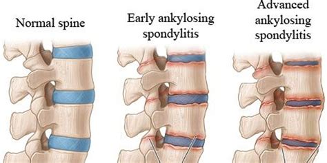 Symptoms of Ankylosing Spondylitis | by Rashika Naman | Medium