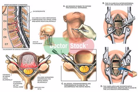 Neck Surgery: Neck Surgery On C4 And C5