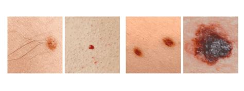 Skin Cancer Moles Early Stages - 10 Signs of Skin Cancer