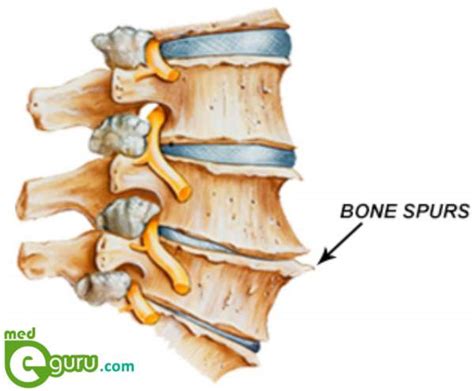 what is a Bone Spur | Bone Spurs TreatmentMed E Guru