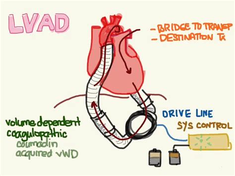 32 best LVAD images on Pinterest | Heart failure, Artificial heart and Er nurses