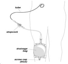 Percutaneous Cholecystostomy