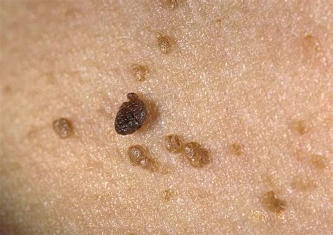 Seborrheic Keratosis: Symptoms, Causes, Diagnosis, and Treatment