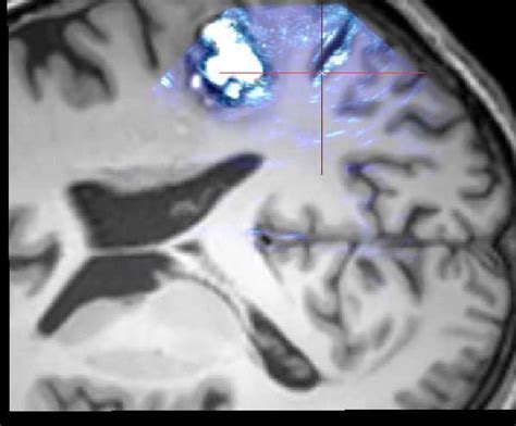 Patient 3 with a cavernoma in central area. Top : result of the rigid ...