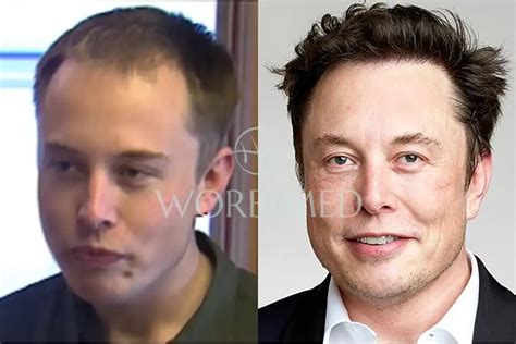 Elon Musk Hair Transplant l Before and After