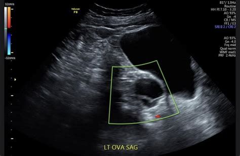 Septated ovarian cyst : r/hysterectomy