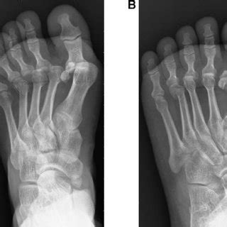 (PDF) Irreducible Metatarsophalangeal Joint Dislocation of the Lesser Toes: A Case Report