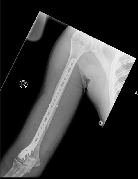 Humerus Fracture: Before and After Surgery : r/brokenbones