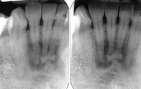 Periapical Cemental Dysplasia Ppt - Classification And Nomenclature Of Fibro Osseous Lesions ...