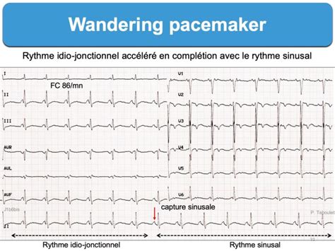 Wandering pacemaker : e-cardiogram