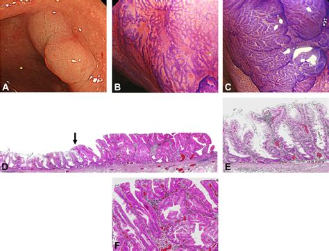 Distinct endoscopic characteristics of sessile serrated adenoma/polyp with and without dysplasia ...