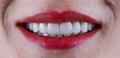 Pros and Cons of Getting Porcelain Veneers on Your Teeth