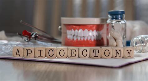 What is Apicoectomy? – MedSleuth