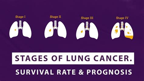 Stages Of Lung Cancer – Survival Rate And Prognosis - Macs Clinic