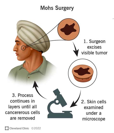 Mohs Surgery: For Skin Cancer, Procedure, Risks, Recovery