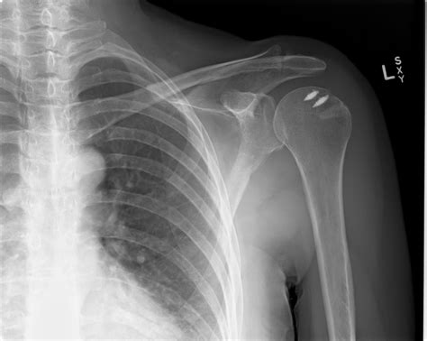 Post operative x-ray of a relatively large size rotator cuff tear with double row medial and ...